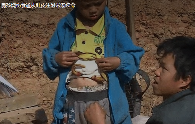 9岁男孩烧伤食道从肚皮注射米汤续命 已获20万捐款